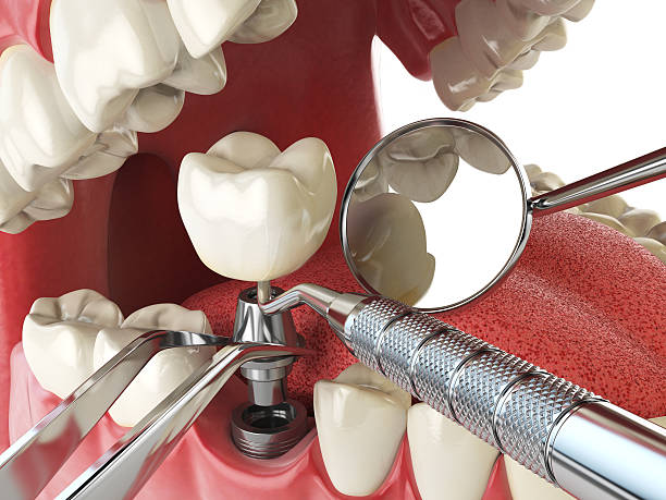 Best Urgent Care for Lost Fillings or Crowns in Bedford, IA